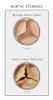Aortic Valve, Normal & Stenosis, Illustration Poster Print by Monica Schroeder/Science Source - Item # VARSCIJB5278