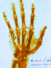 X-ray of Gunshot in the Hand Poster Print by Science Source - Item # VARSCIBS4855