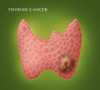 Thyroid Cancer Poster Print by Monica Schroeder/Science Source - Item # VARSCIJC2623