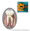 Oral Infection of Fusobacterium Nucleatum Poster Print by Gwen Shockey/Science Source - Item # VARSCIJB3225