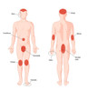 Areas of the Body Affected by Psoriasis Poster Print by Spencer Sutton/Science Source - Item # VARSCIBY8018
