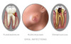 Oral Infections, Illustration Poster Print by Gwen Shockey/Science Source - Item # VARSCIJB3251