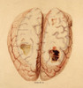 Extravasated Blood, Brain, Illustration, 1855 Poster Print by Science Source