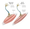 Normal Nerve and ALS Nerve Poster Print by Spencer Sutton/Science Source