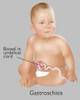 Baby with Gastroschisis Poster Print by Gwen Shockey/Science Source - Item # VARSCIBY2344