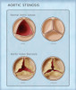 Aortic Valve, Normal & Stenosis, Illustration Poster Print by Monica Schroeder/Science Source - Item # VARSCIJB5281