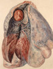 Lung, Tubercular Blood Clot, Illustration, 1894 Poster Print by Science Source