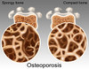Osteoporotic & Normal Bone Poster Print by Gwen Shockey/Science Source - Item # VARSCIBY3823