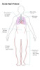 Acute Heart Failure Poster Print by Spencer Sutton/Science Source - Item # VARSCIBY8000