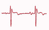 Normal ECG Poster Print by Science Source - Item # VARSCIBW6643