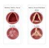 Aortic Valve Comparison Poster Print by Monica Schroeder/Science Source - Item # VARSCIBY4114