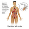 Multiple Sclerosis and Nerves Poster Print by Gwen Shockey/Science Source - Item # VARSCIBZ3667