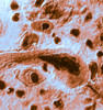 Advanced Lung Cancer Poster Print by Science Source - Item # VARSCIBQ7000