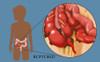 Ruptured Appendix Poster Print by Monica Schroeder/Science Source