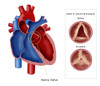 Aortic Valve Stenosis Poster Print by Monica Schroeder/Science Source - Item # VARSCIBY4118