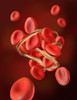 Thrombosis, Illustration Poster Print by Spencer Sutton/Science Source - Item # VARSCIJA6009