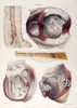Heart, Aneurysm, Illustration, 1838 Poster Print by Science Source - Item # VARSCIJA1797