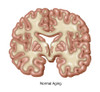 Normal Aging Brain Poster Print by Gwen Shockey/Science Source - Item # VARSCIJC6242