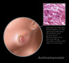 Oral Infection of Actinomycosis Poster Print by Gwen Shockey/Science Source - Item # VARSCIJB3244