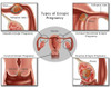 Ectopic Pregnancy Poster Print by Gwen Shockey/Science Source - Item # VARSCIBZ7429