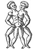 Conjoined Twins, 16th Century Poster Print by Science Source - Item # VARSCIBY1394