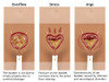 Types of Incontinence Poster Print by Gwen Shockey/Science Source - Item # VARSCIBZ3764
