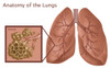 Lungs & Alveoli with Emphysema Poster Print by Gwen Shockey/Science Source - Item # VARSCIBZ3721