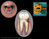 Oral Infection of Fusobacterium Nucleatum Poster Print by Gwen Shockey/Science Source - Item # VARSCIJB3214