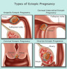 Ectopic Pregnancy Poster Print by Gwen Shockey/Science Source - Item # VARSCIBZ7432