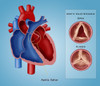 Aortic Valve Stenosis Poster Print by Monica Schroeder/Science Source - Item # VARSCIBY4115