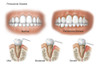 Three stages of periodontal disease. Poster Print by TriFocal Communications/Stocktrek Images - Item # VARPSTTRF700099H