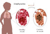 Alveoli Comparison, Emphysema Poster Print by Monica Schroeder/Science Source - Item # VARSCIBZ9029