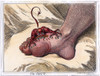 Gout, 1799. /N'The Gout.' Etching, 1799, By James Gillray. Poster Print by Granger Collection - Item # VARGRC0009717