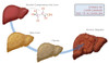 Stages of Liver Damage Poster Print by Monica Schroeder/Science Source - Item # VARSCIBY6893