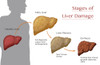 Stages of Liver Damage Poster Print by Monica Schroeder/Science Source - Item # VARSCIBY6945