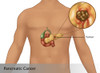 Pancreatic Cancer in Male Figure, Illustration Poster Print by Gwen Shockey/Science Source - Item # VARSCIJA8144