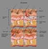 Eczema Poster Print by Gwen Shockey/Science Source