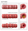 Bronchoconstriction, Asthma Poster Print by Monica Schroeder/Science Source - Item # VARSCIBZ9043