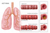 Bronchoconstriction, Asthma Poster Print by Monica Schroeder/Science Source - Item # VARSCIBZ9040