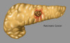 Pancreatic Cancer, Illustration Poster Print by Gwen Shockey/Science Source - Item # VARSCIJA8129