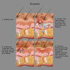 Eczema Poster Print by Gwen Shockey/Science Source - Item # VARSCIBW7431