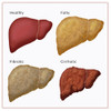 Stages of Liver Damage Poster Print by Monica Schroeder/Science Source - Item # VARSCIBY6899
