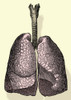 Human Lungs Poster Print by Science Source - Item # VARSCIBJ5641