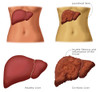 Healthy vs. Cirrhotic Liver Poster Print by Monica Schroeder/Science Source - Item # VARSCIBY6927