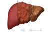 Liver Comparison Poster Print by Monica Schroeder/Science Source - Item # VARSCIBY6941