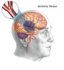 Ischemic Stroke Poster Print by Spencer Sutton/Science Source - Item # VARSCIBZ8067