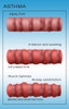 Bronchoconstriction, Asthma Poster Print by Monica Schroeder/Science Source - Item # VARSCIBZ9046