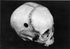 Do Not Use./Ntrepanning: Skull. /Ntrepanned Pre-Columbian Skull Found In Peru. Poster Print by Granger Collection - Item # VARGRC0018247