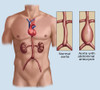 Abdominal Aneurysm Poster Print by Spencer Sutton/Science Source - Item # VARSCIBZ8021