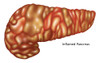 Inflamed Pancreas, Illustration Poster Print by Gwen Shockey/Science Source - Item # VARSCIJA8136